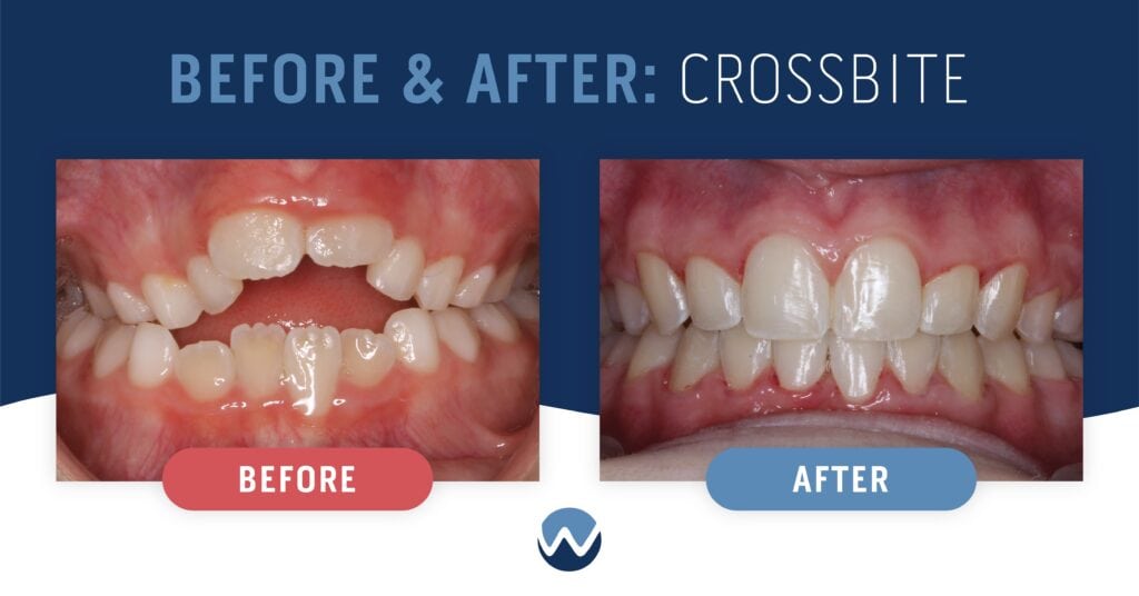 Patient "GP": Before and After Crossbite Comparison