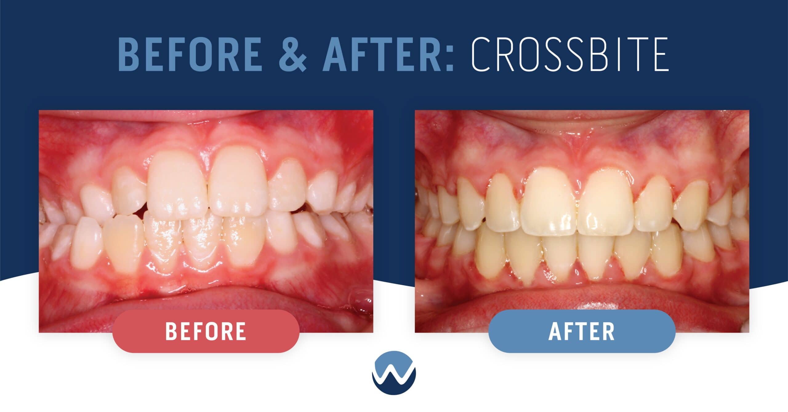 Patient "KD": Before and After Crossbite Comparison 1