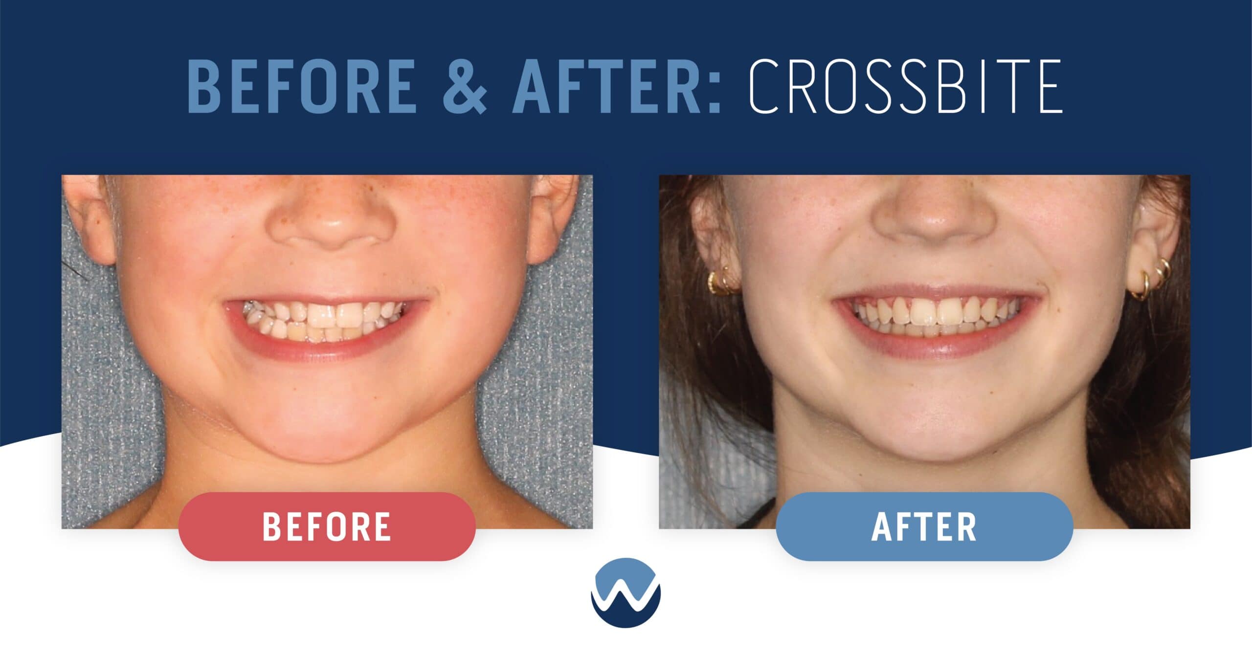 Patient "KD": Before and After Crossbite Comparison 2