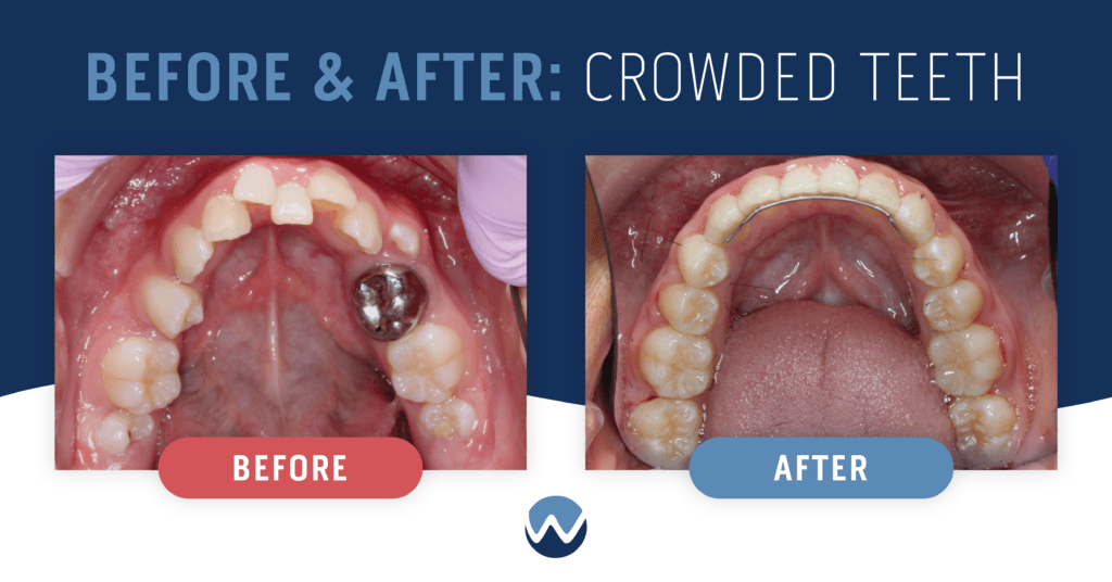 Ways We Can Help With Teeth Crowding • Woodhill Dental Specialties