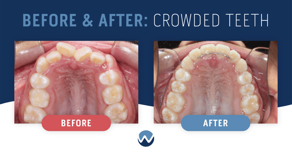 Ways We Can Help With Teeth Crowding • Woodhill Dental Specialties