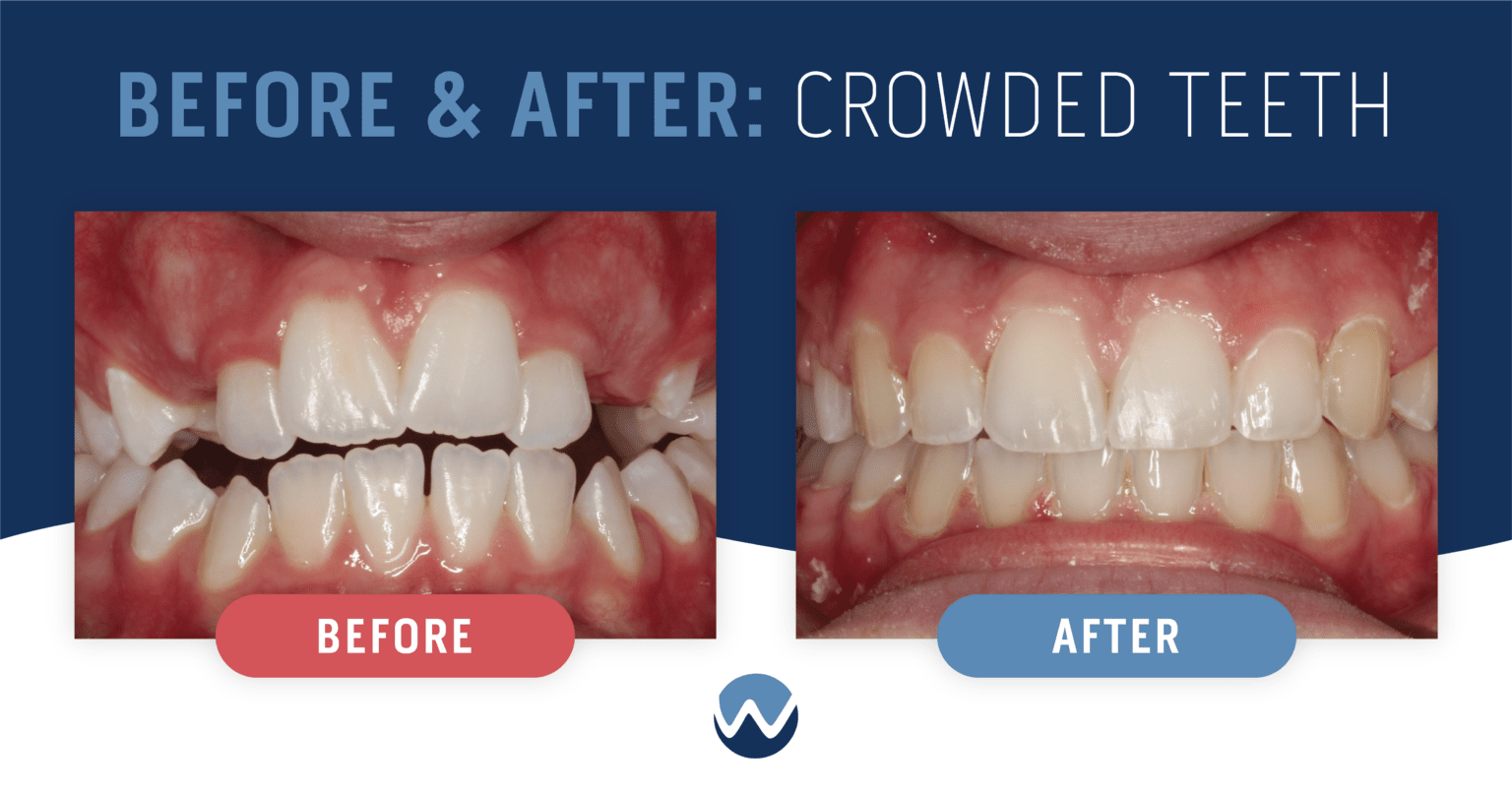 Ways We Can Help With Teeth Crowding • Woodhill Dental Specialties