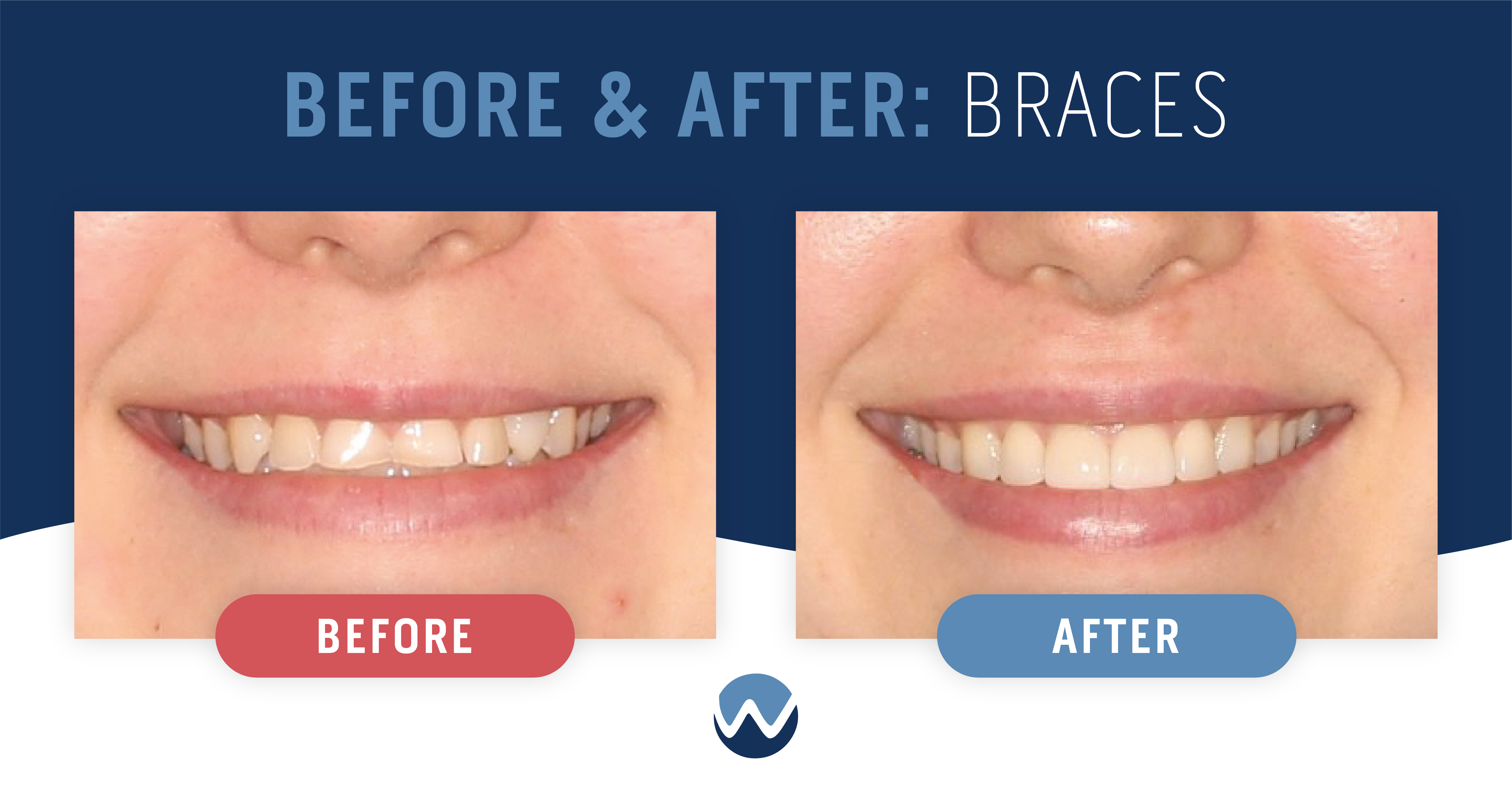 Before & After Braces See the Amazing Results Yourself! • Woodhill
