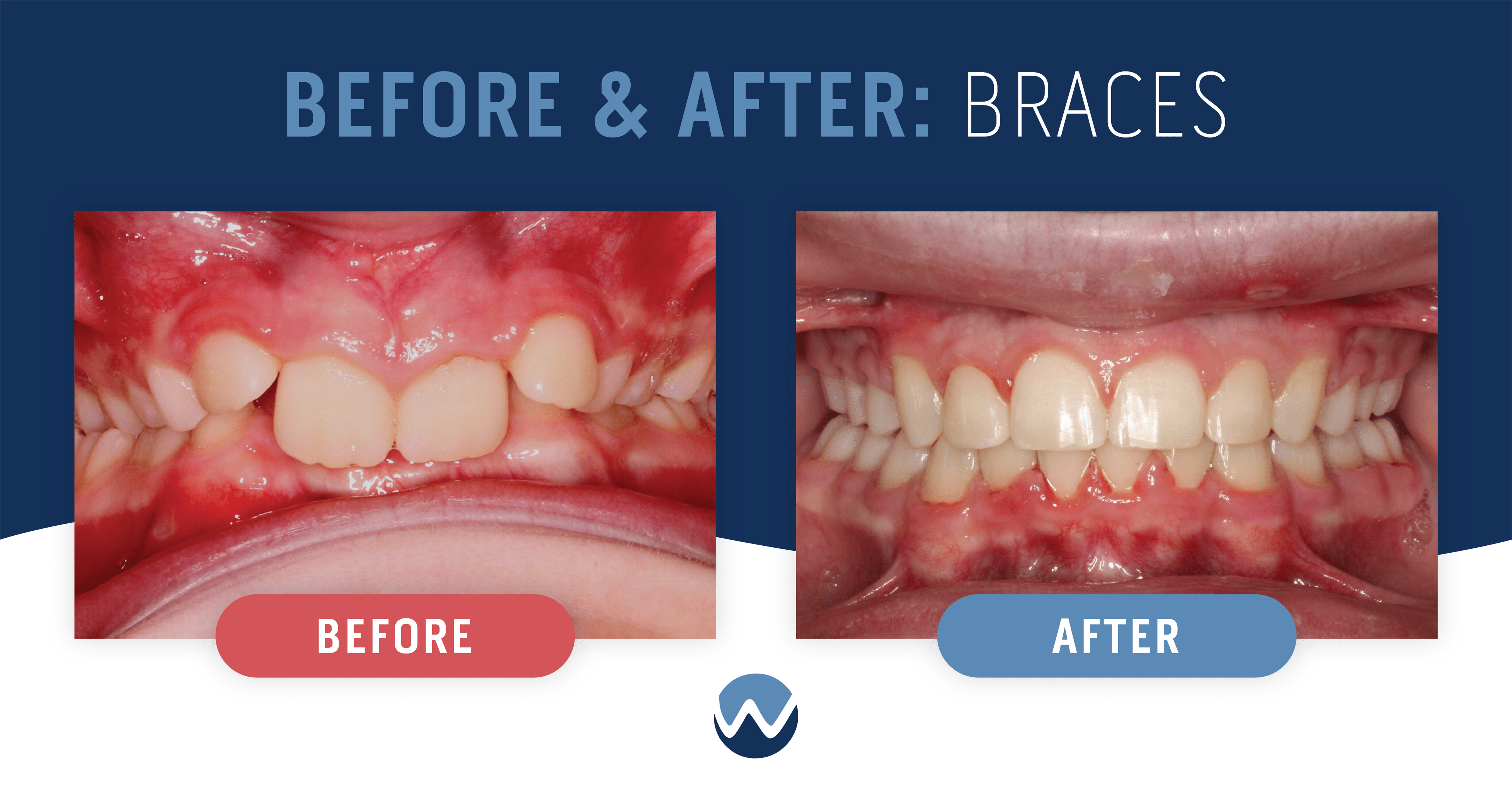 Before & After Braces See the Amazing Results Yourself! • Woodhill Dental Specialties