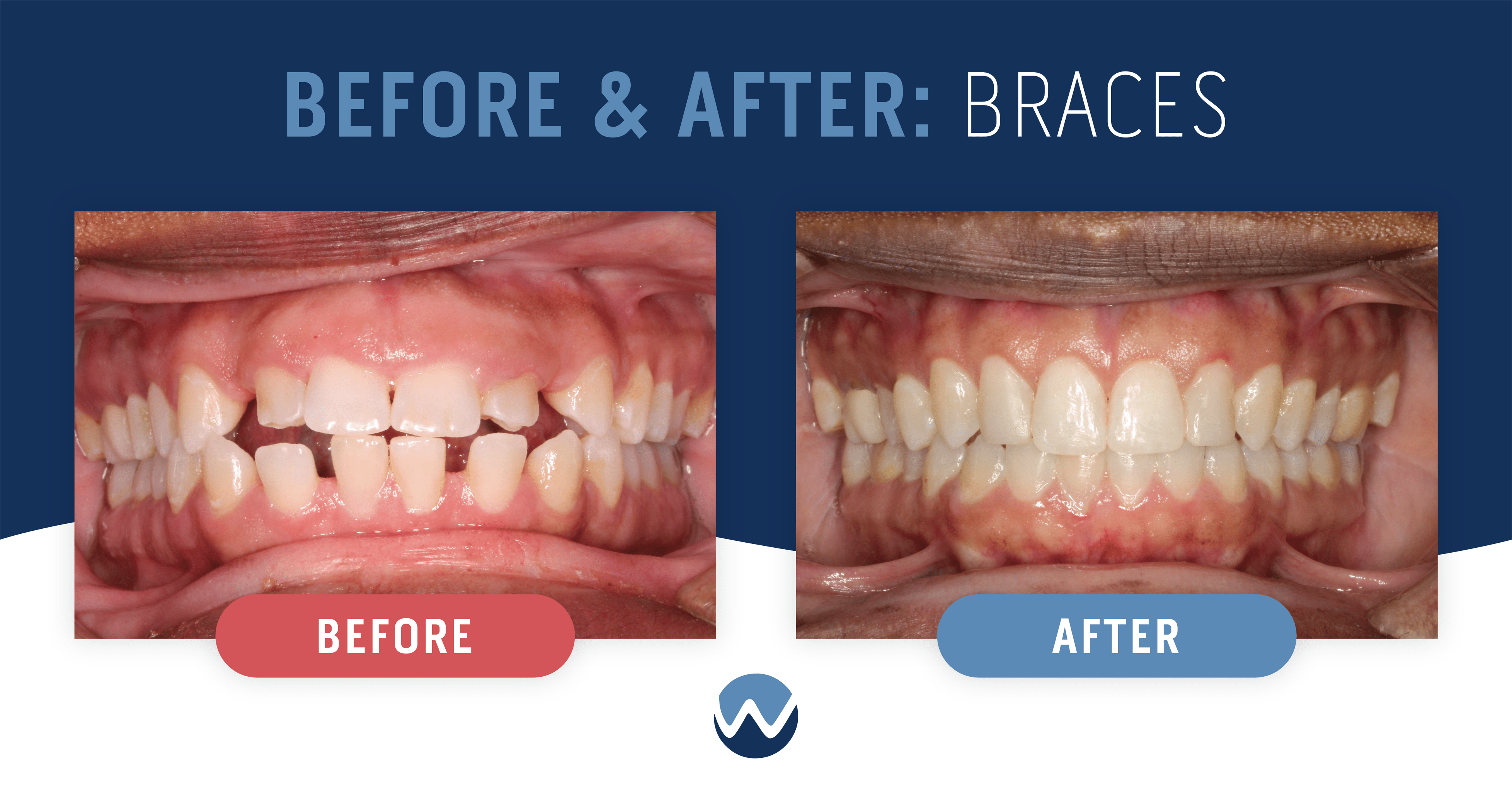 buck teeth before and after braces