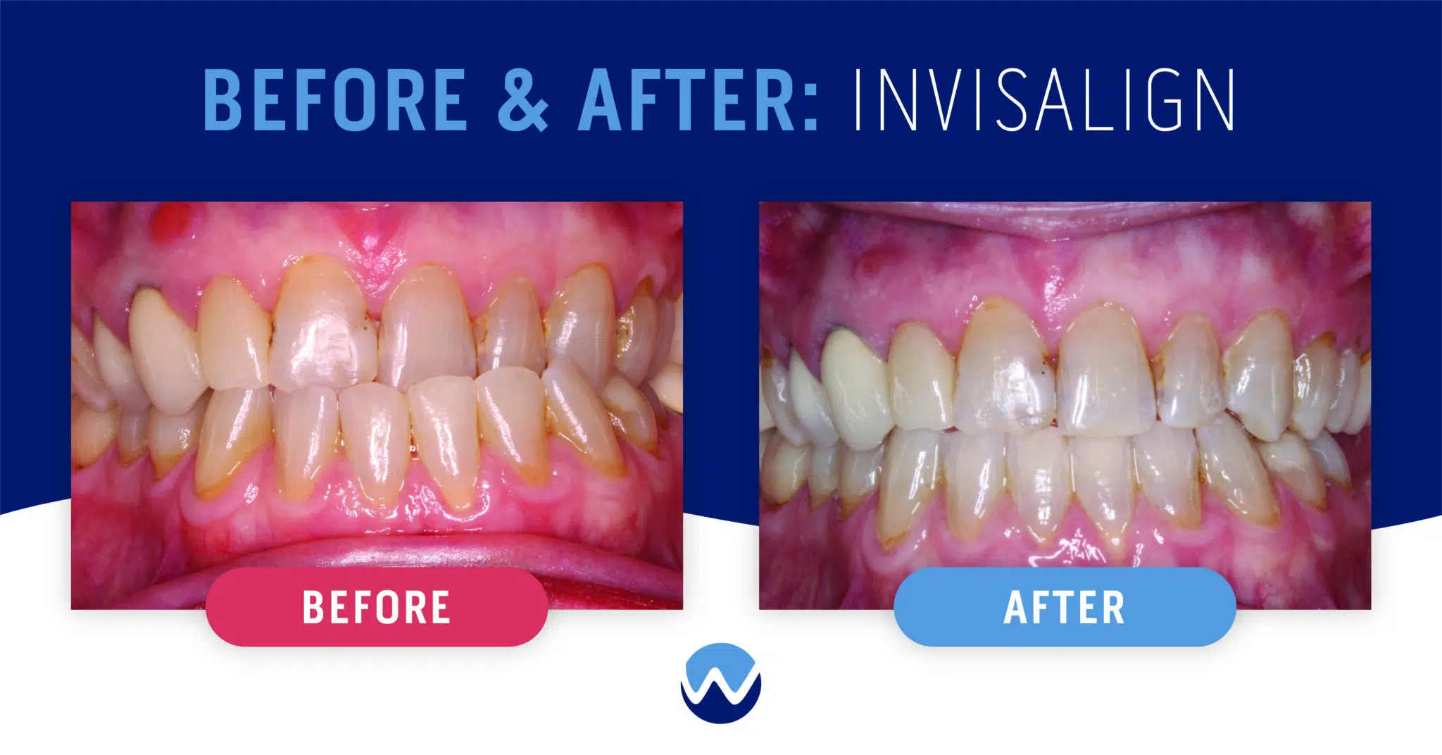 Clear Aligners Before & After: See How They Transform Smiles