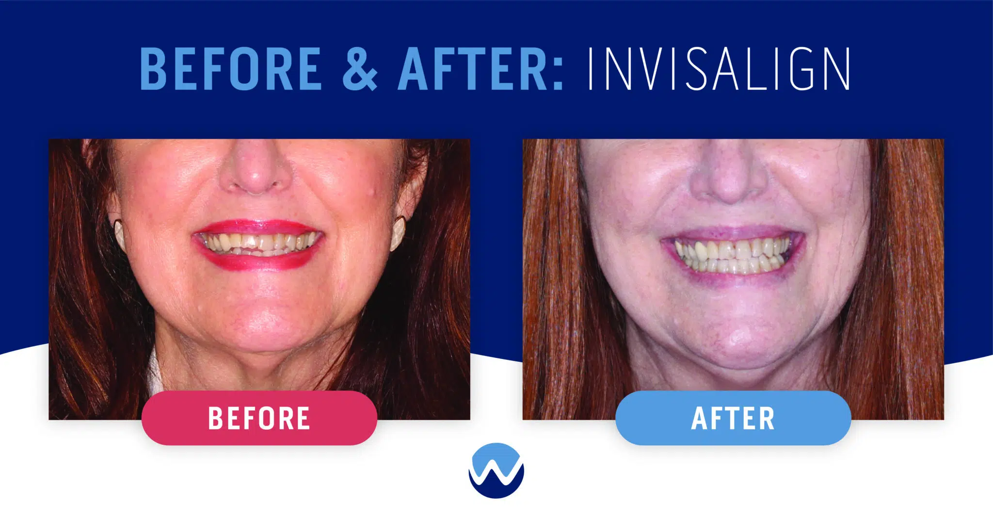 Clear Aligners Before & After: See How They Transform Smiles • Woodhill  Dental Specialties