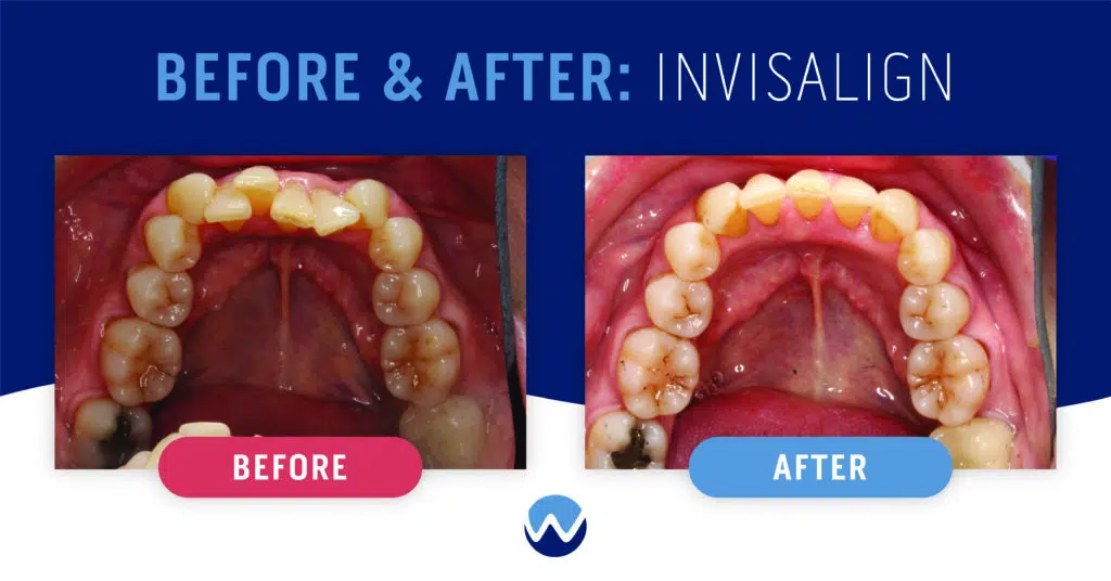 Clear Aligners Before & After: See How They Transform Smiles • Woodhill  Dental Specialties